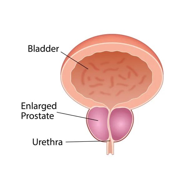 Prostate Enlargement treatment by unani medicine | Sana Herbals Dehlvi